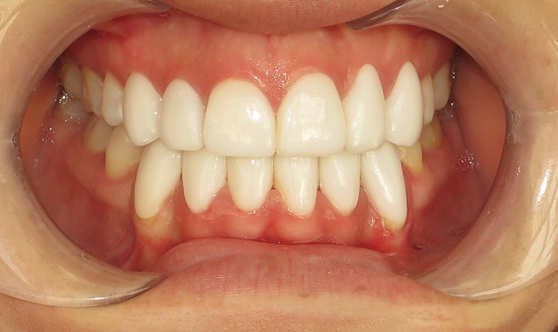 Porcelain Veneer Cases case 165 — after