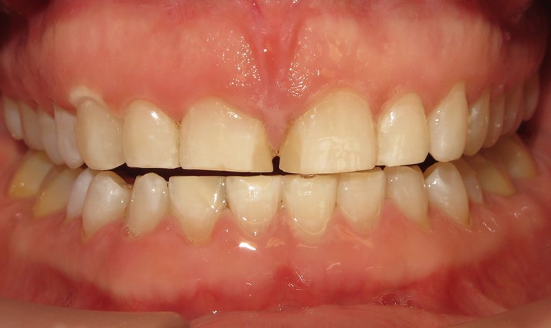 Porcelain Veneer Cases case 167 — before