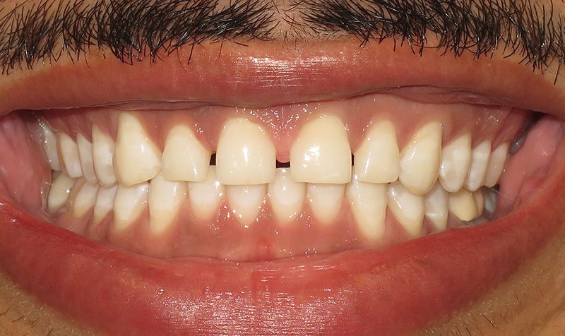 Porcelain Veneer Cases case 168 — before