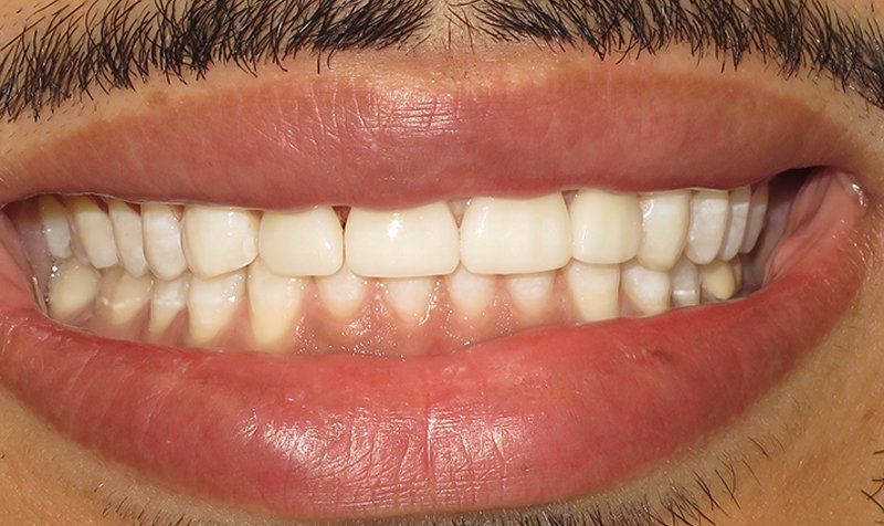 Porcelain Veneer Cases case 168 — after