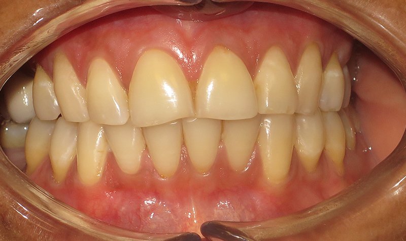 Porcelain Veneer Cases case 169 — before