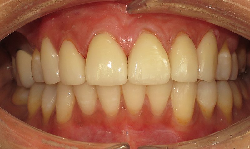 Porcelain Veneer Cases case 169 — after