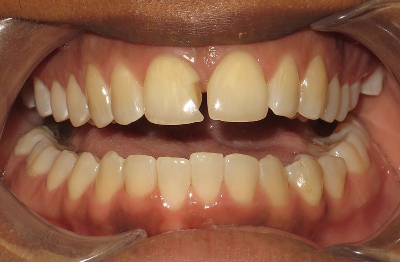 Porcelain Veneer Cases case 185 — before