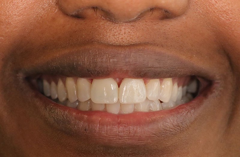 Porcelain Veneer Cases case 185 — after