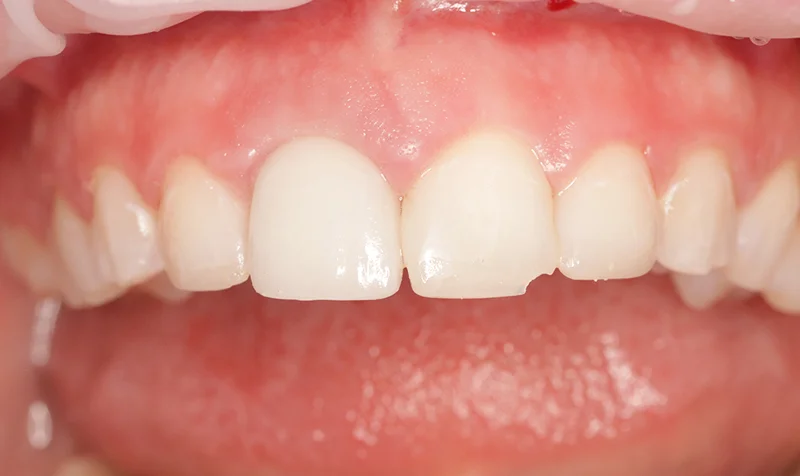 Porcelain Veneer Cases case 192 — before