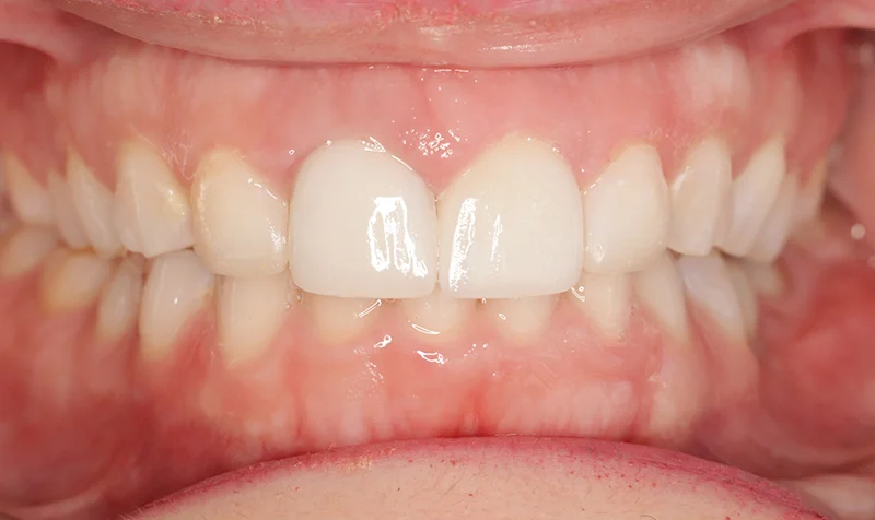 Porcelain Veneer Cases case 192 — after