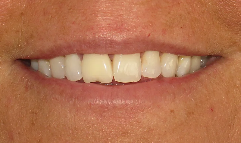 Porcelain Veneer Cases case 193 — before