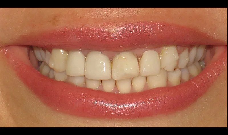 Porcelain Veneer Cases case 208 — before