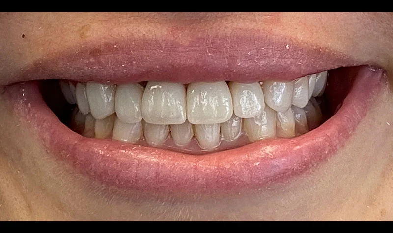 Porcelain Veneer Cases case 208 — after