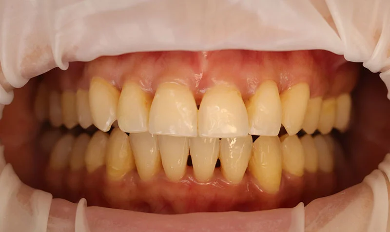 Porcelain Veneer Cases case 209 — before