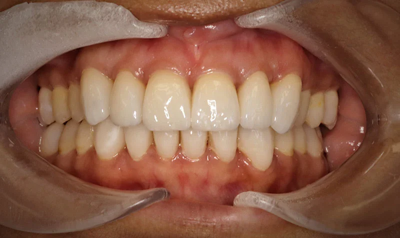 Porcelain Veneer Cases case 209 — after