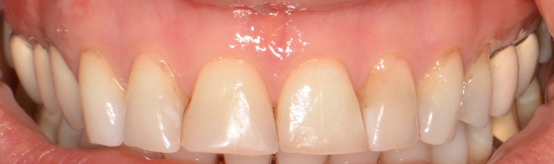 Porcelain Veneer Cases case 62 — before