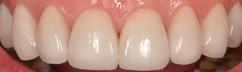 Porcelain Veneer Cases case 62 — after