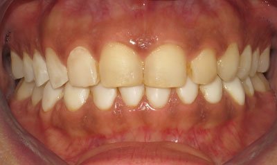 Porcelain Veneer Cases case 74 — before