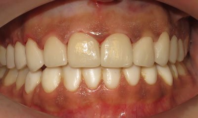 Porcelain Veneer Cases case 74 — after