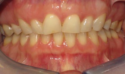 Porcelain Veneer Cases case 76 — before