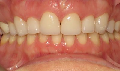 Porcelain Veneer Cases case 76 — after