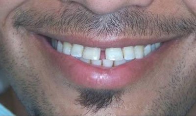 Porcelain Veneer Cases case 5 — before