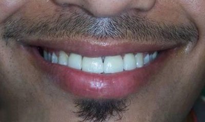 Porcelain Veneer Cases case 5 — after