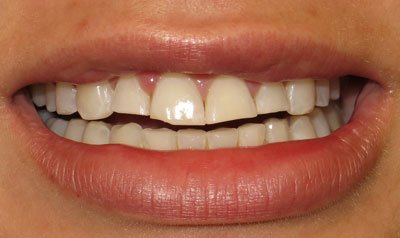Porcelain Veneer Cases case 11 — before
