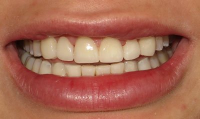 Porcelain Veneer Cases case 11 — after
