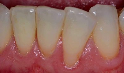 Recession & Root Coverage case 105 — before