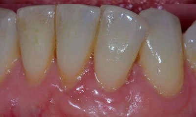 Recession & Root Coverage case 105 — after