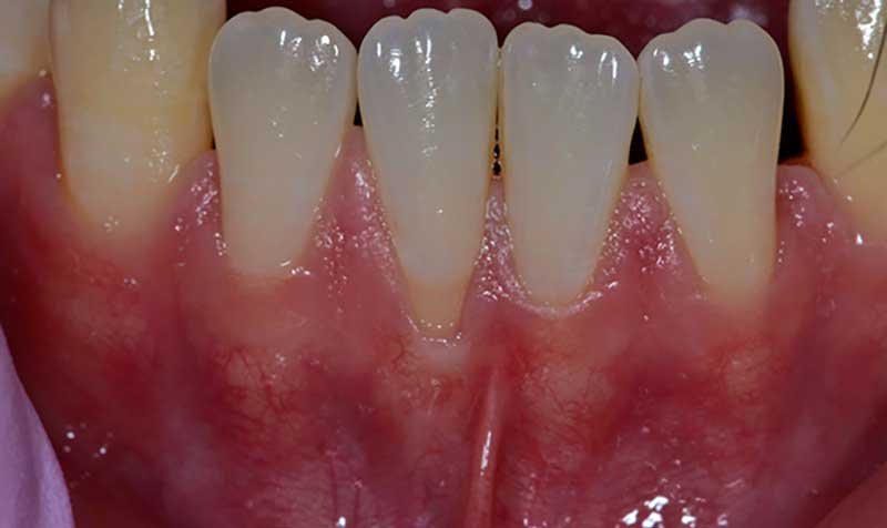 Recession & Root Coverage case 119 — before