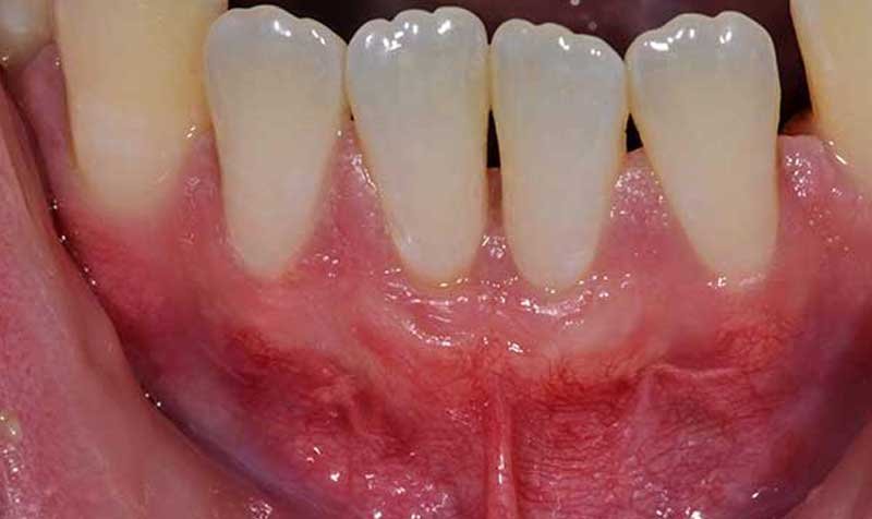 Recession & Root Coverage case 119 — after