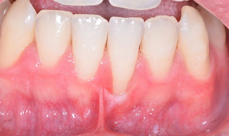 Recession & Root Coverage case 143 — before