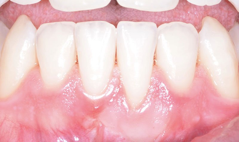Recession & Root Coverage case 143 — after
