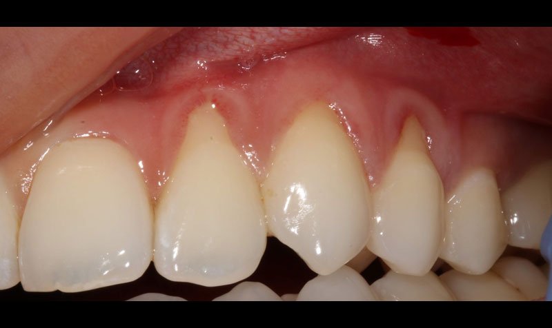 Recession & Root Coverage case 155 — before