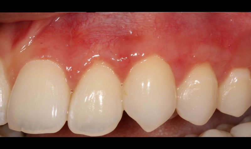 Recession & Root Coverage case 155 — after