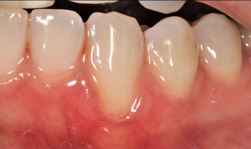 Recession & Root Coverage case 198 — before