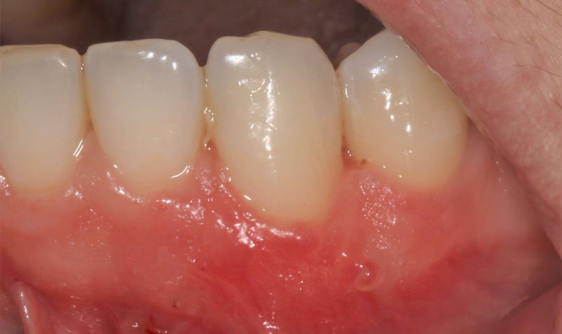 Recession & Root Coverage case 198 — after