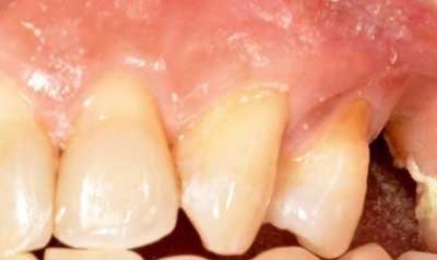 Recession & Root Coverage case 38 — before