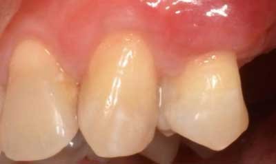 Recession & Root Coverage case 38 — after