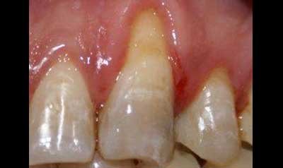 Recession & Root Coverage case 39 — before