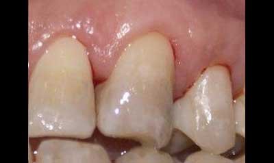 Recession & Root Coverage case 39 — after