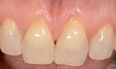 Recession & Root Coverage case 40 — before