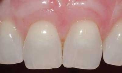 Recession & Root Coverage case 40 — after