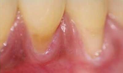 Recession & Root Coverage case 41 — before