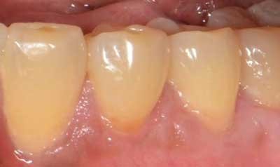 Recession & Root Coverage case 41 — after