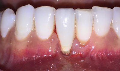 Recession & Root Coverage case 53 — before