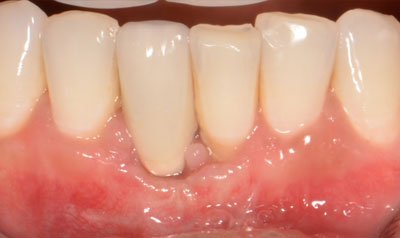 Recession & Root Coverage case 53 — after