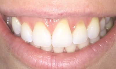 Recession & Root Coverage case 54 — before