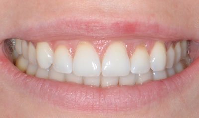 Recession & Root Coverage case 54 — after