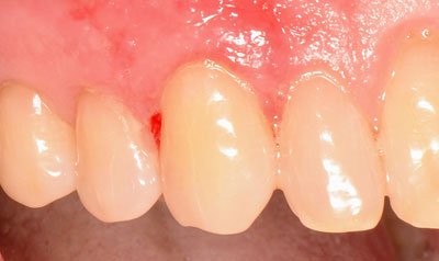 Recession & Root Coverage case 58 — after