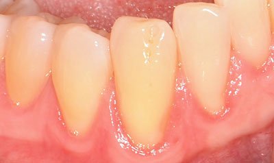 Recession & Root Coverage case 59 — before