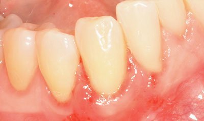 Recession & Root Coverage case 59 — after